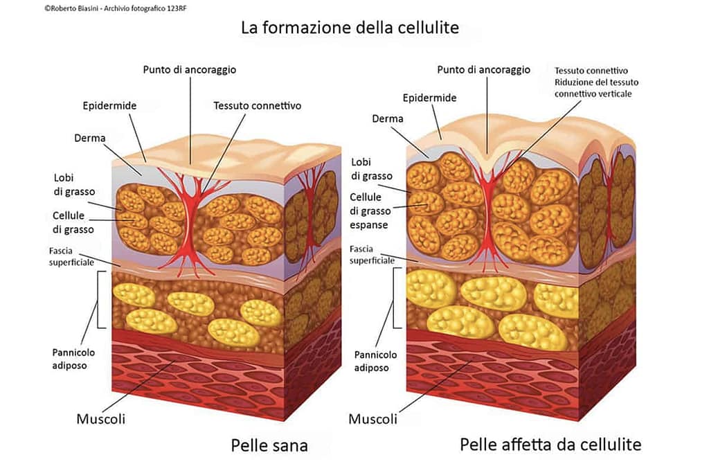 cellulite