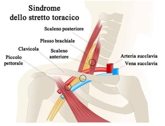 Affrontare la sindrome dello stretto toracico: fisioterapia come opzione terapeutica