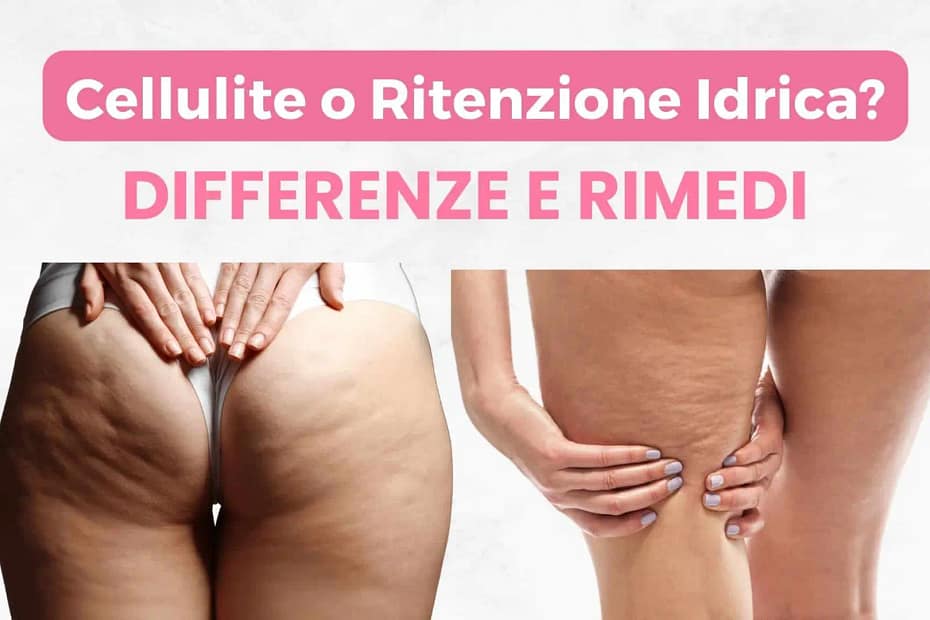 cellulite o ritenzione idrica